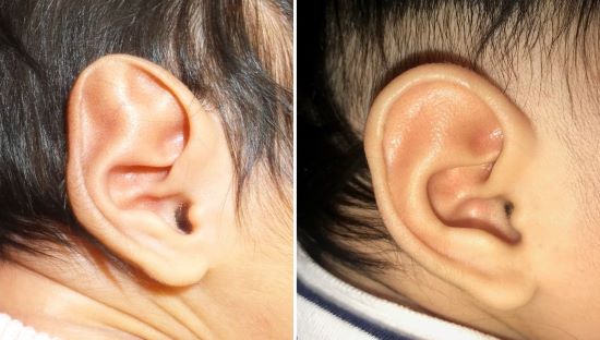 What is Ear Molding?